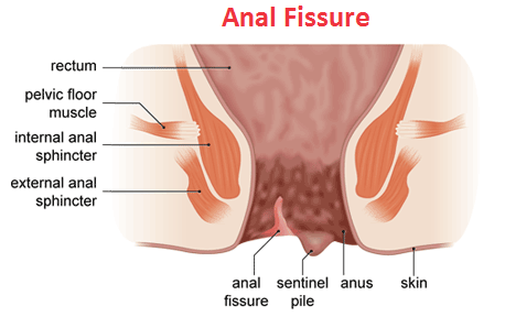 Anal Fissures